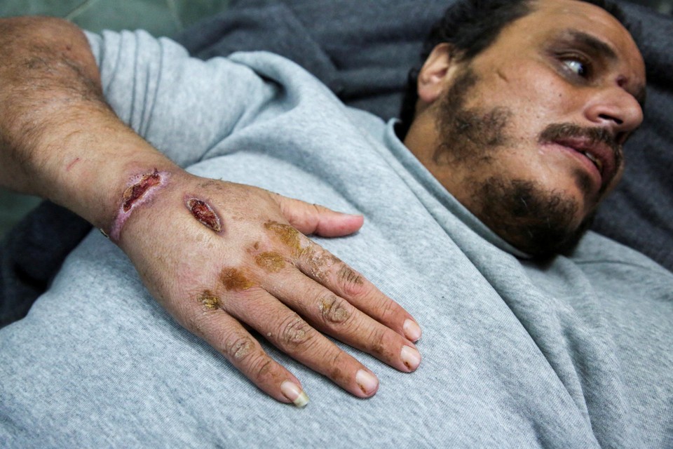 Een pas vrijgelaten Palestijn heeft littekens op zijn hand van wat hij martelingen noemt tijdens zijn detentie.