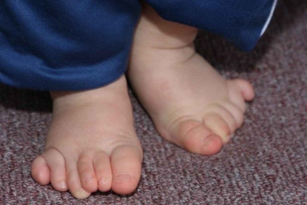 creëren Verbazing Klooster Baby wordt geboren met 12 vingers en 14 tenen | Gazet van Antwerpen Mobile