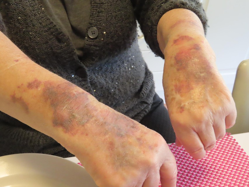 Celine toont de verwondingen aan haar armen.
