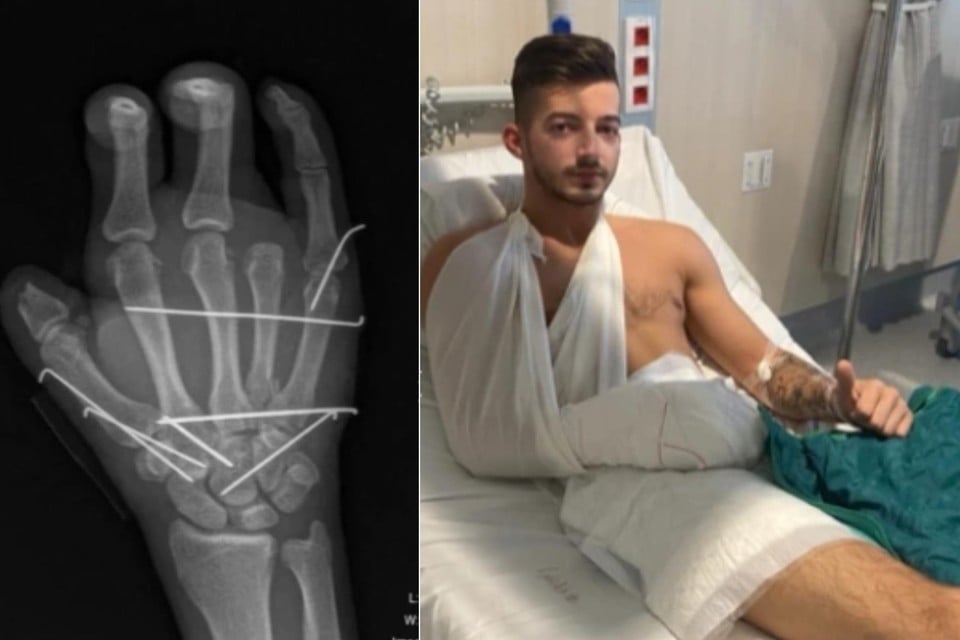 Jordy verloor zijn ringvinger en een groot stuk van zijn duim na de coronabetoging in Brussel. 