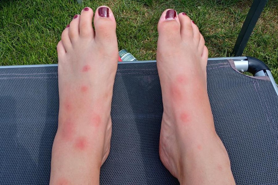 Dit zijn de voeten vol muggenbeten van Yana uit Lanaken. We krijgen er spontaan jeuk van. 