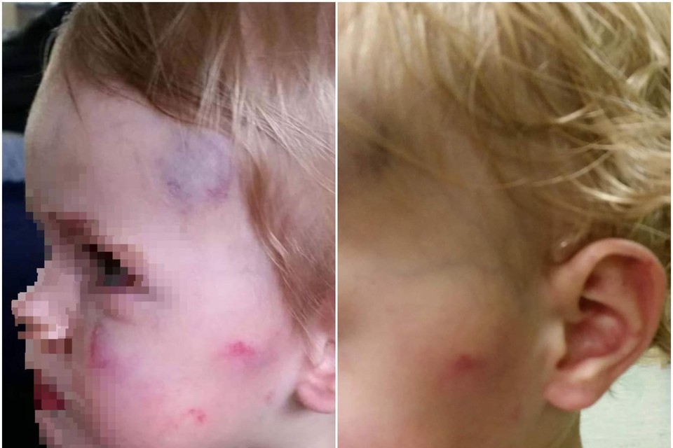 De foto’s die de kinderarts maakte, werden bestudeerd door de wetsdokter. De twee waren het eens: het kind werd mishandeld.